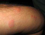 Bed Bug bites on human skin